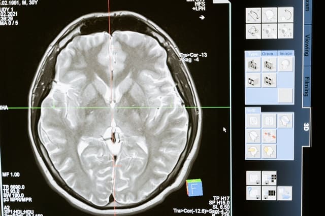 Rentgenový snímek mozku.