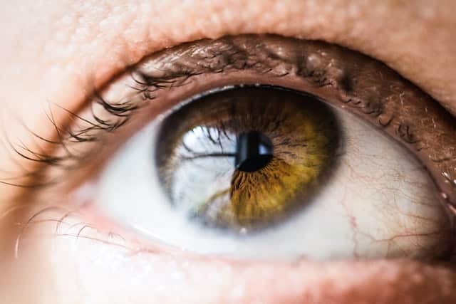 Suché oko jako jeden z příznaků lupusu.